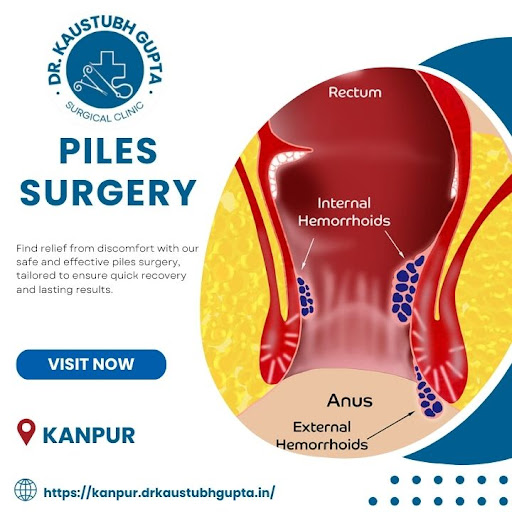 Best Piles Doctor in Kanpur – Expert Care by Dr. Kasutubh Gupta